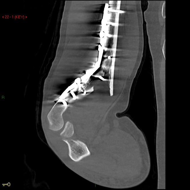 Figure 3 for case Re-fracture distal humerus